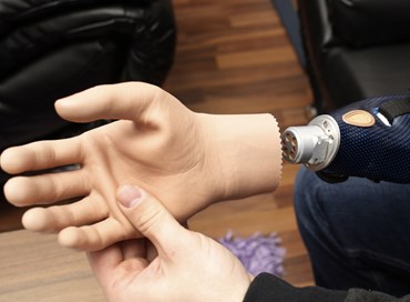Una mano bionica è stata impiantata su una donna italiana