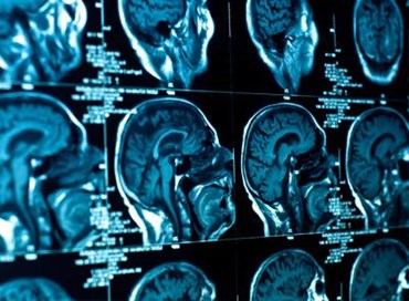 A Napoli il XV Congresso mondiale di Neuroradiologia interventistica