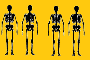 Osteoporosi: la malattia ladra di ossa (video)